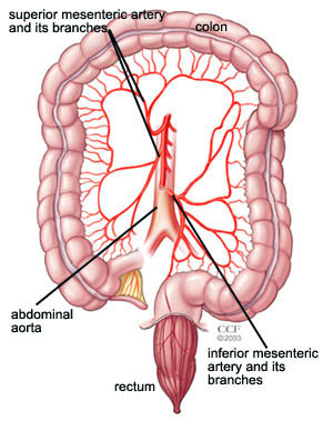 Intestinal Ischemia