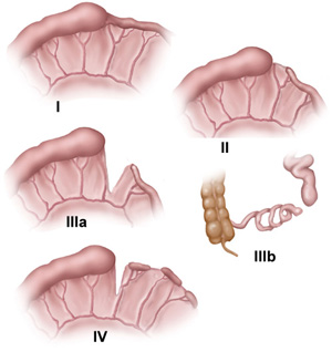 Jujunoileal Atresia