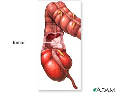 Tumor