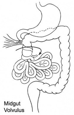 Intestinal Volvulus