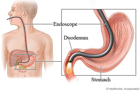 endoscopy